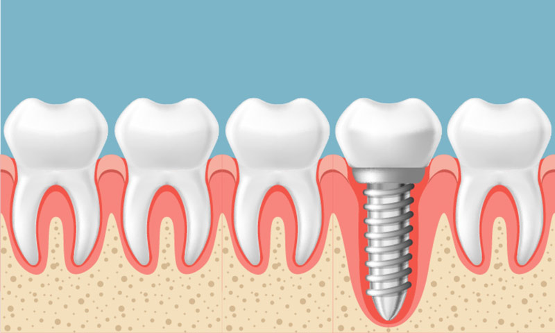 implantes+dentales+murcia